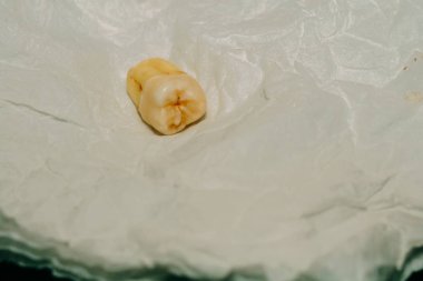 Diş çıkarma sonra