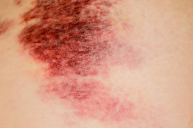 piel humana con el acné