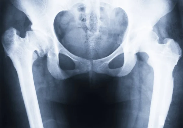 X-ray of deformed hip — Stock Photo, Image