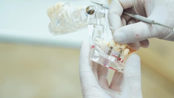 顎のレイアウト上のインプラントの偽の歯のデモンストレーション 白いゴム手袋と入れ歯の歯科医 — ストック動画