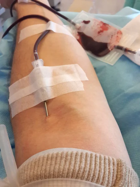 Arm met naald tijdens bloedtransfusie — Stockfoto