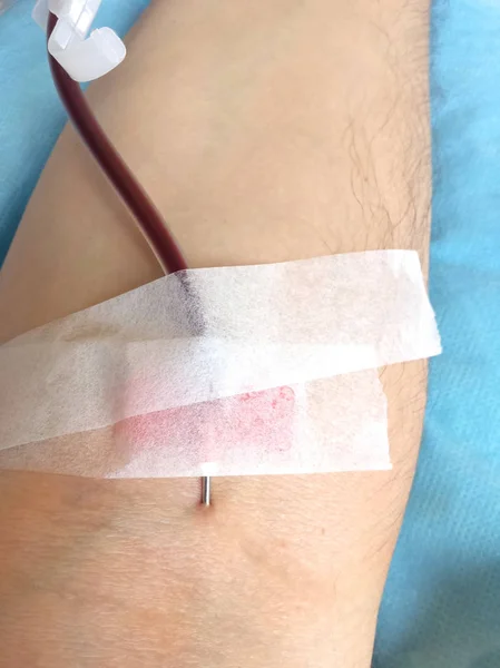 Arm av en man i ett sjukhus under transfusion av blod med — Stockfoto