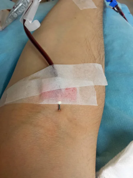 Arm av en man på sjukhuset när donera blod med nålen — Stockfoto