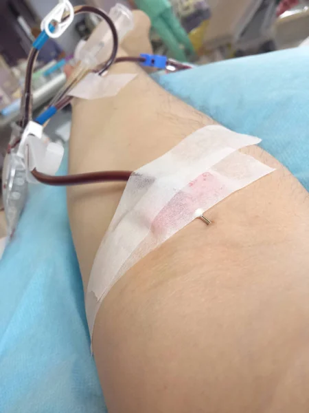 Bras d'un homme dans un hôpital pendant la transfusion de sang avec — Photo