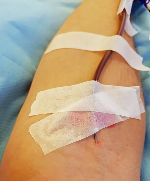 Prélèvement sanguin et bras du patient pendant la transfusion sanguine avec le — Photo