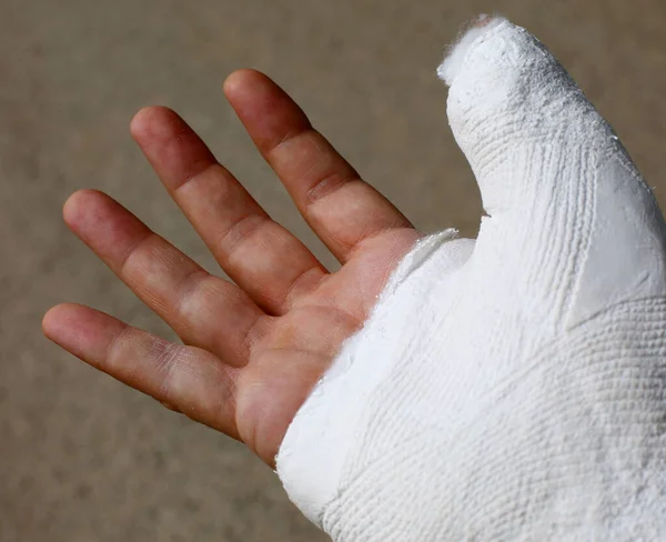 Hand plastered after a fracture — Stock Photo, Image