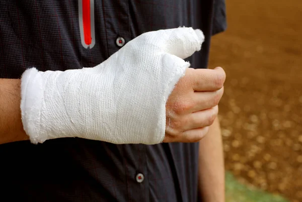 Personne avec le pouce et le poignet plâtrés après la fracture de — Photo