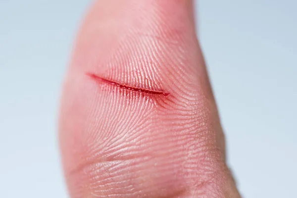 Close up of lesion on white background — Stock Photo, Image