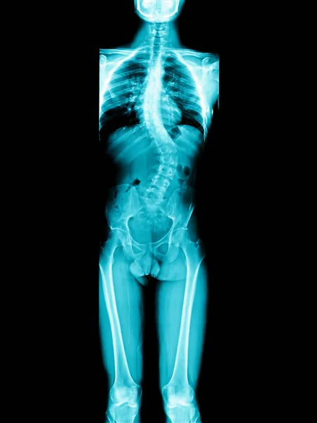 Zdjęcie rentgenowskie człowieka mają ciało kości długich — Zdjęcie stockowe