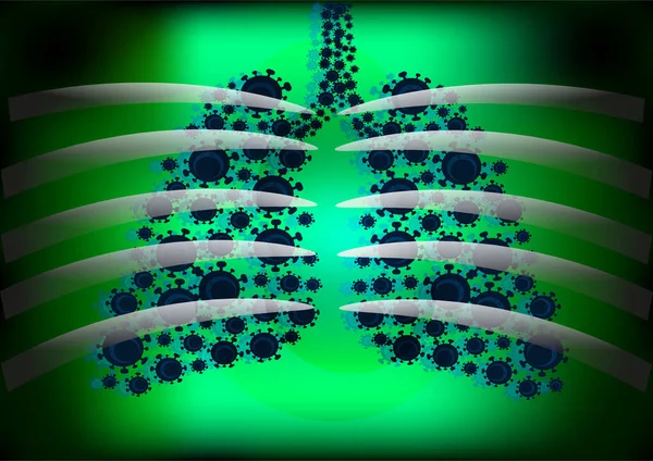 X-ray film of Coronavirus disease COVID-19 virus infection in human lungs, new corona virus infection or COVID (novel Coronavirus 2019 disease,COVID-19,nCoV,SARS-Cov-2) pandemic outbreak as respiratory syndrome.