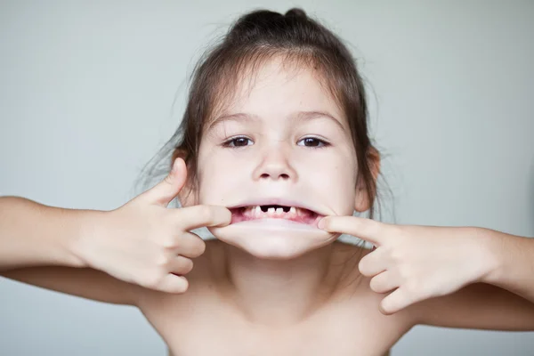 Menina mostrando seus dentes de leite desaparecidos — Fotografia de Stock