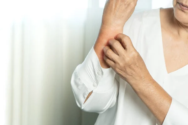 Mulheres Idosas Coçar Mão Coceira Braço Eczema Cuidados Saúde Medicina — Fotografia de Stock