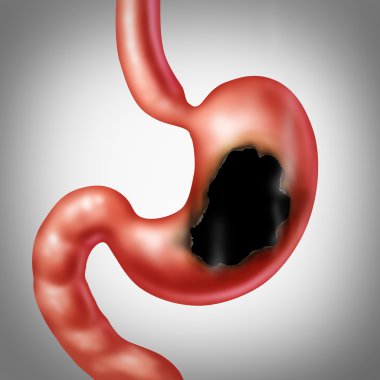 Stomach Ulcer Medical Concept clipart