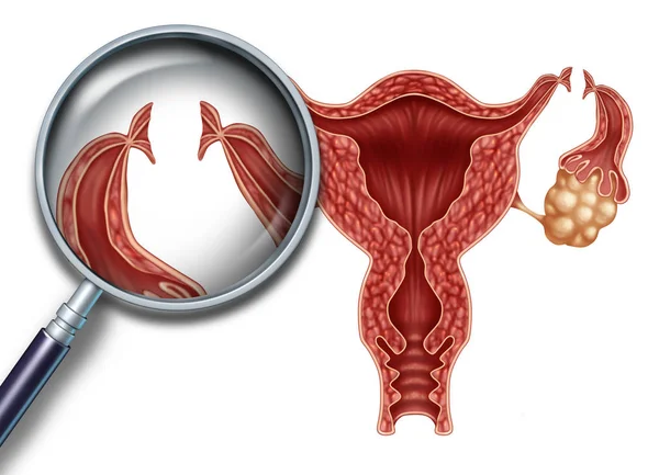 Tubal Ligation koncept — Stockfoto