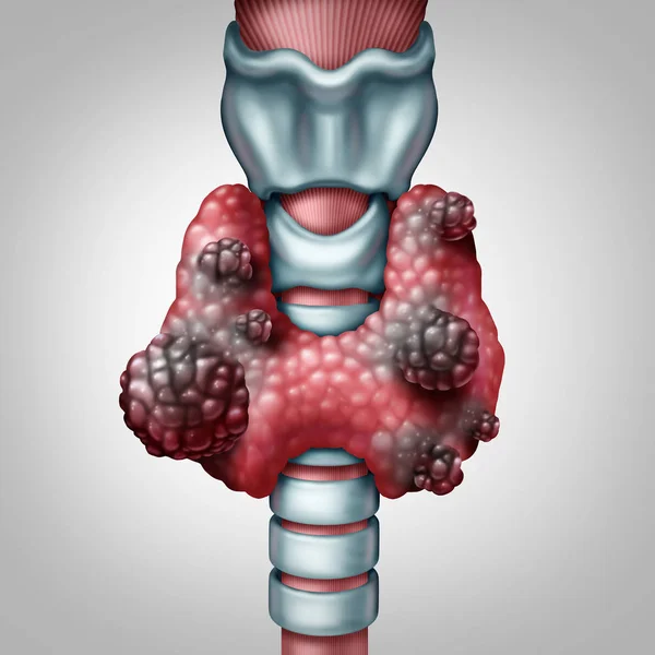 Concept de cancer de la thyroïde — Photo
