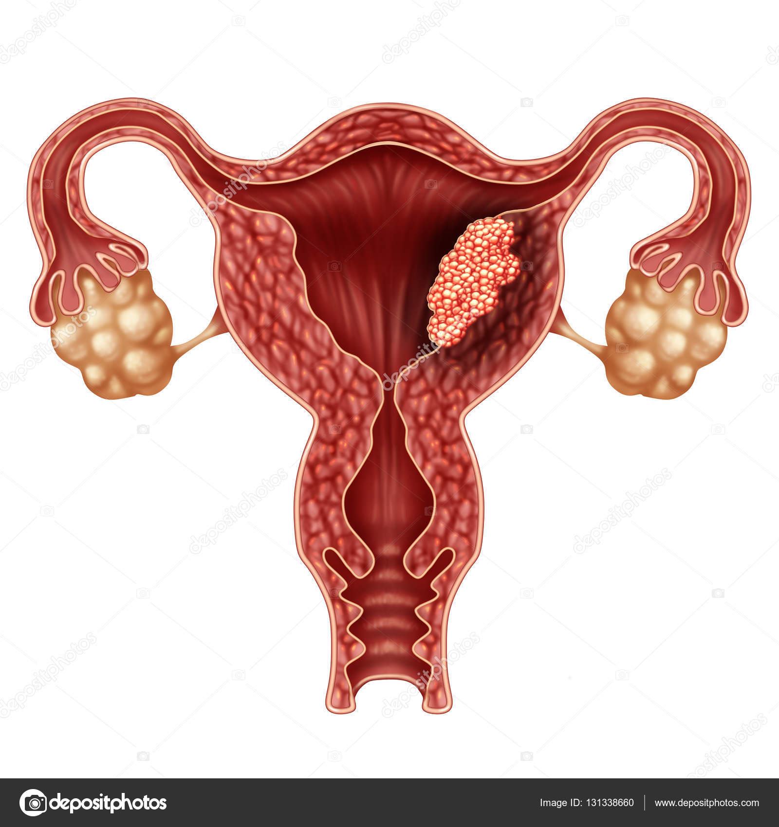 endometrial cancer svenska endometrial cancer svenska
