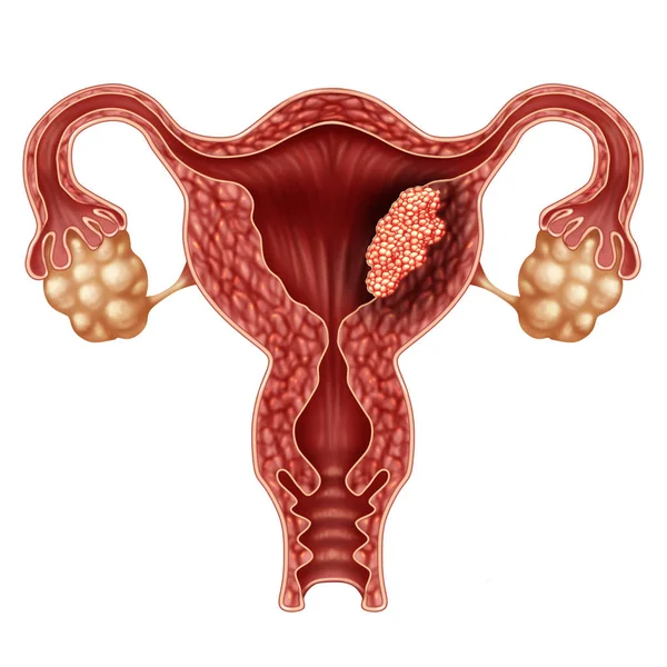 Concepto de cáncer de endometrio — Foto de Stock