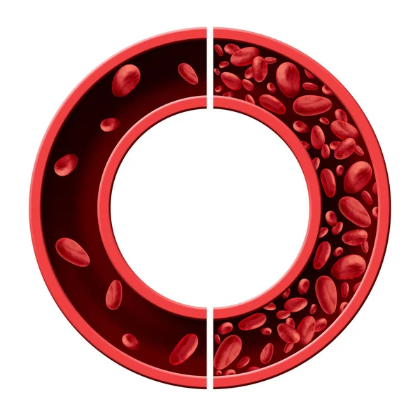 Bloedarmoede anemie Concept Diagram — Stockfoto