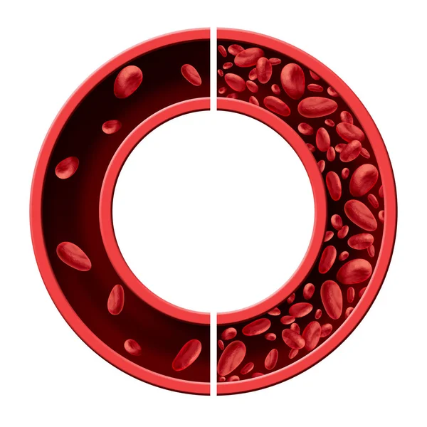 Anemia niedokrwistość pojęcie diagramu — Zdjęcie stockowe