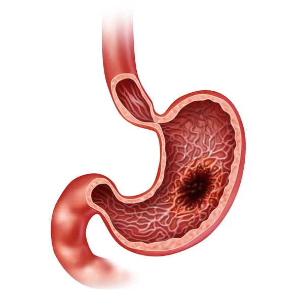 Stomach Cancer Concept — Stock Photo, Image