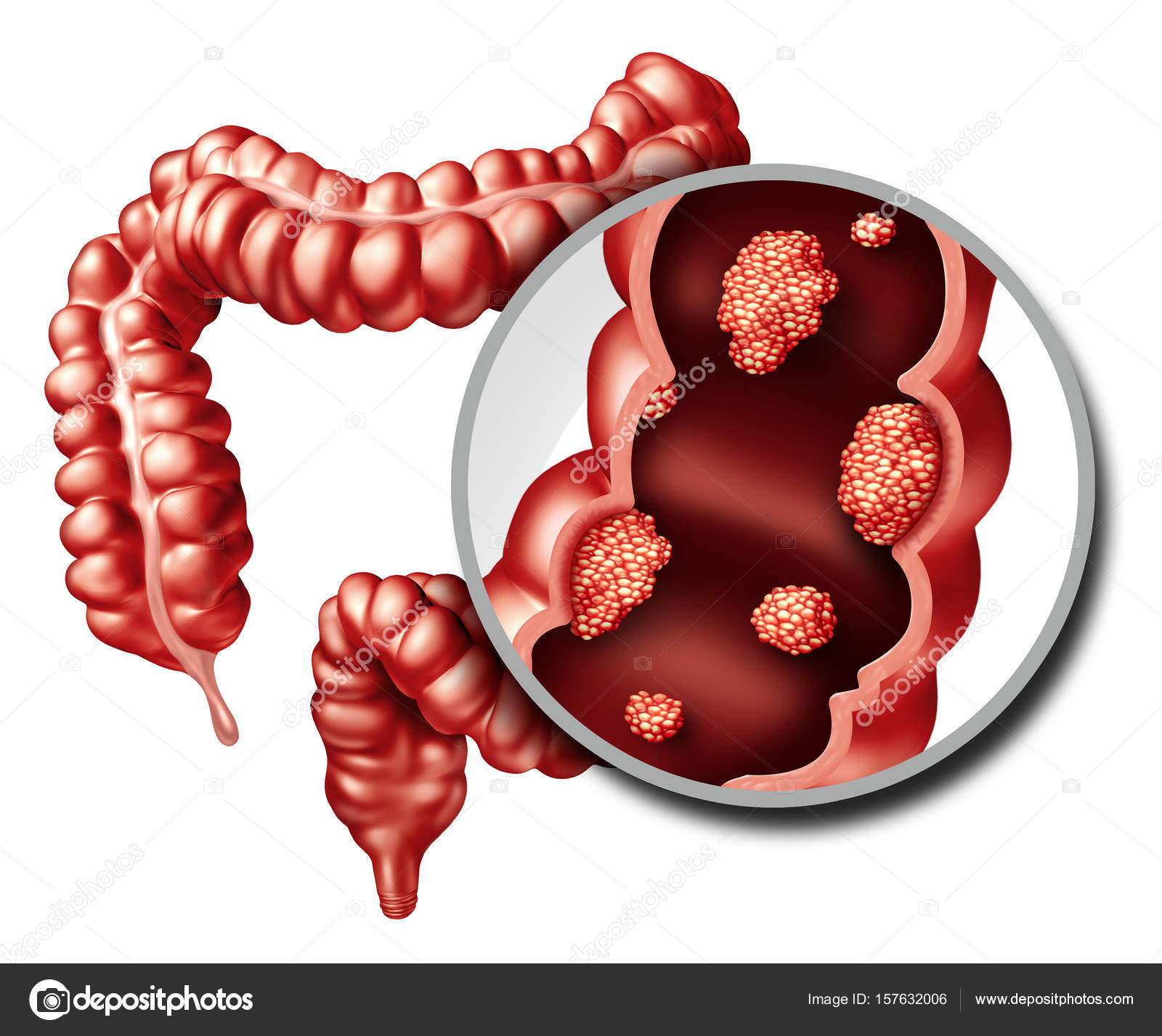 Colon Cancer Pictures Colon Cancer Stock Photos Images Depositphotos