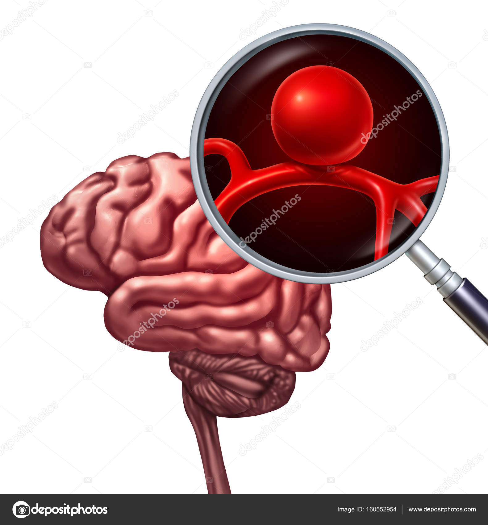 brain aneurysm svenska