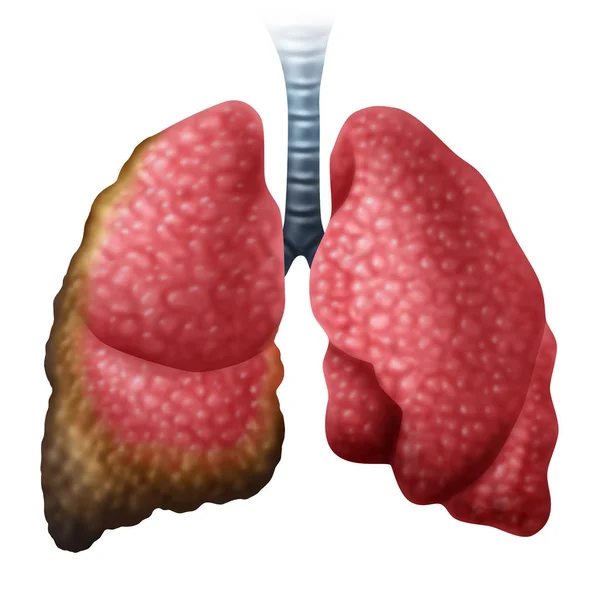 Concepto de la enfermedad del cáncer del mesotelioma —  Fotos de Stock