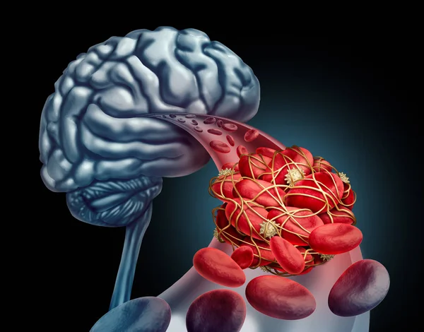 Blood Clot Brain — Stock Photo, Image