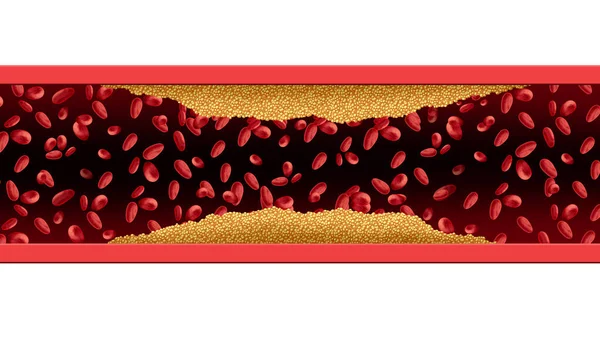 Artery Cholesterol Risk — Stock Photo, Image