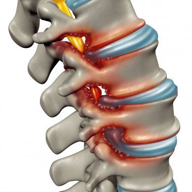 Spinal Stenosis clipart