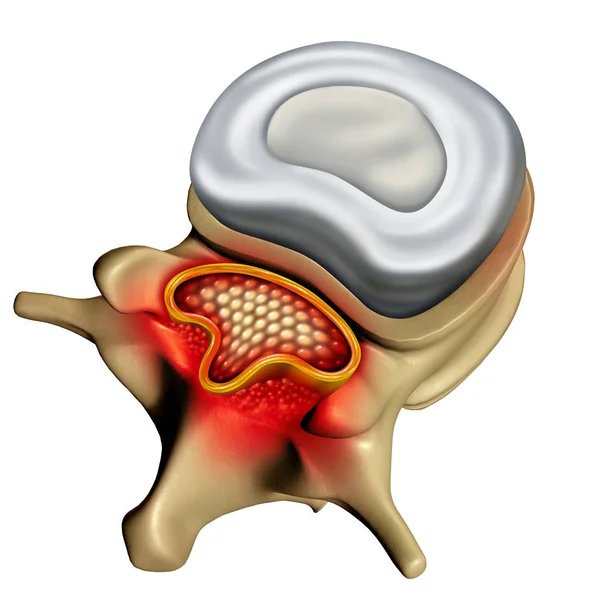 Concepto de estenosis espinal — Foto de Stock