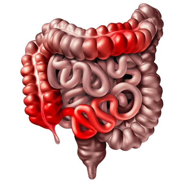 Enfermedad de Crohn — Foto de Stock