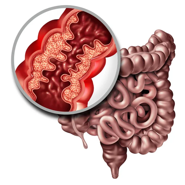 Penyakit Crohn — Stok Foto