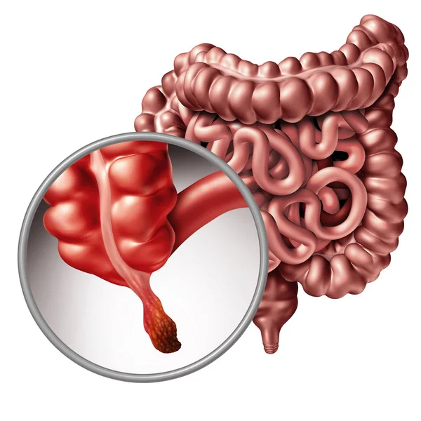 Apendicitis — Foto de Stock