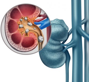 Kidney Stone clipart