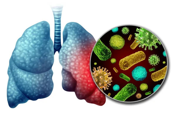 Pneumonia Anatomia da Infecção — Fotografia de Stock