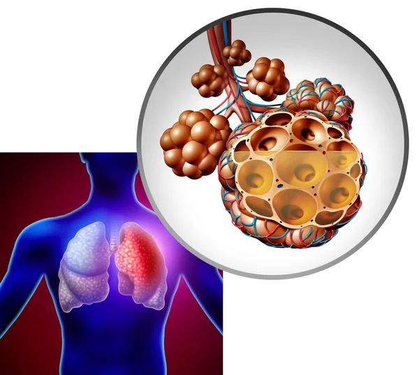 Neumonía pulmonar humana — Foto de Stock