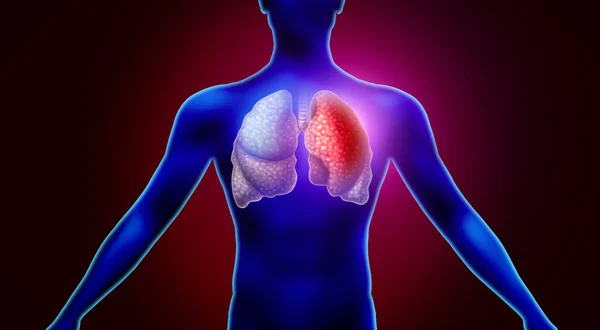 Human Lung Infection — Stock Photo, Image