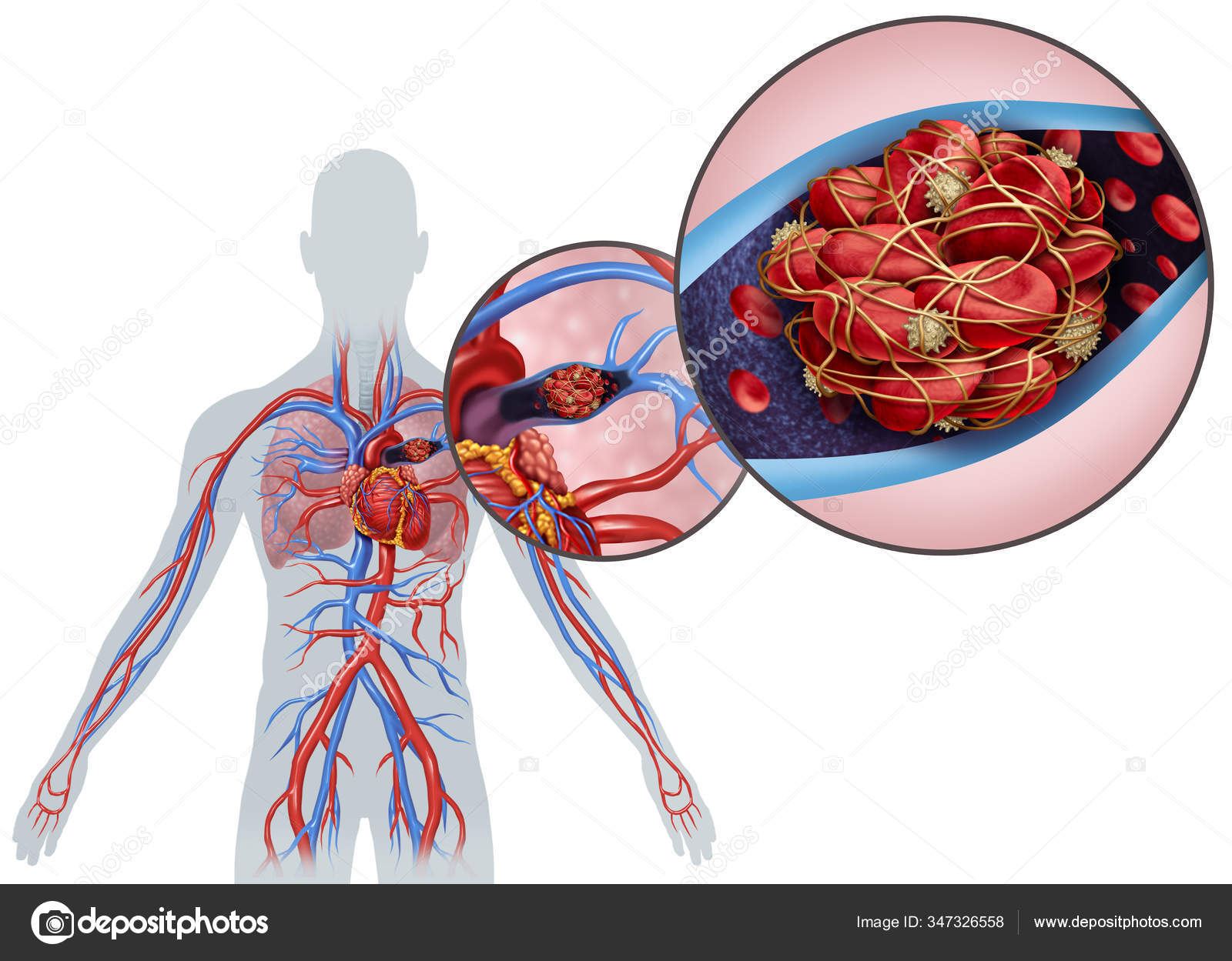 depositphotos_347326558-stock-photo-pulmonary-embolism-blood-clot-disease.jpg