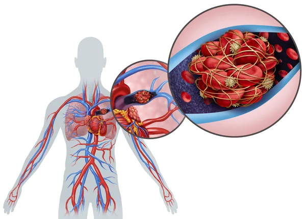 Pulmonale Mbolisme Met Een Bloedstolsel Als Een Ziekte Met Een — Stockfoto