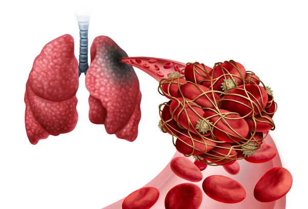 肺の動脈の閉塞と疾患として血塊と肺のエンボリズム3Dイラスト要素 — ストック写真
