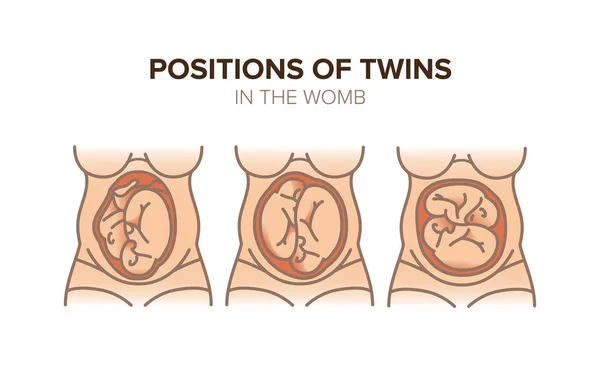 Positie van een tweeling in de baarmoeder. Zwangerschap Rechtenvrije Stockillustraties