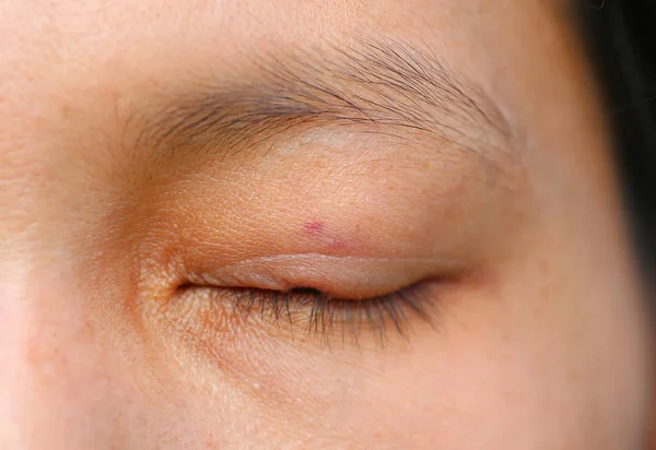 Ránu medicínu na oční víčko, po odstranění fleck nebo mateřské znaménko laserem. — Stock fotografie