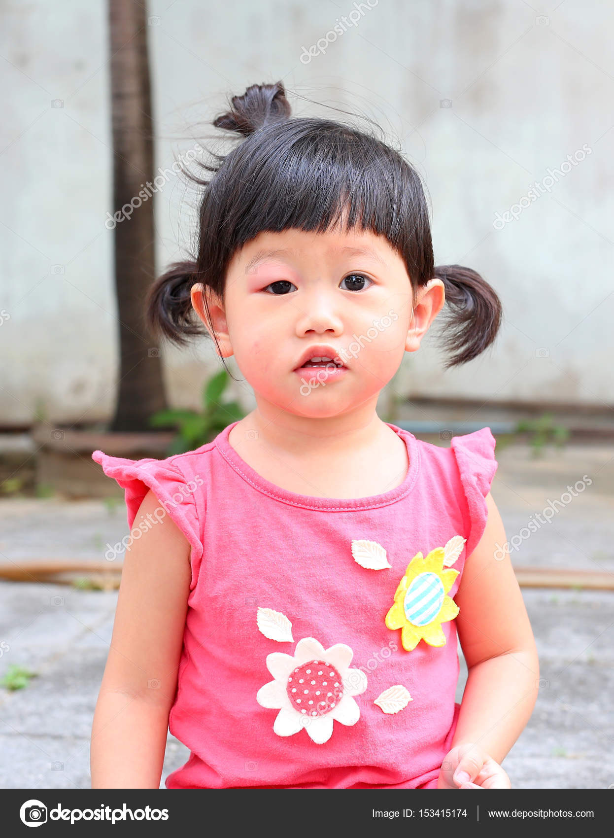 Asiatique Bebe Fille Oeil Houle Allergie Apres Les Moustiques Mordant A L Oeil Petite Fille Image Libre De Droit Par Civic Dm Hotmail Com C