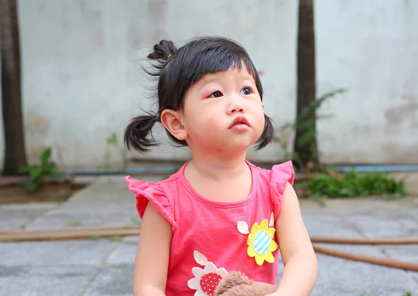 Azjatki baby girl oczu puchnąć, alergii po komary gryzący w oczy mała dziewczynka — Zdjęcie stockowe