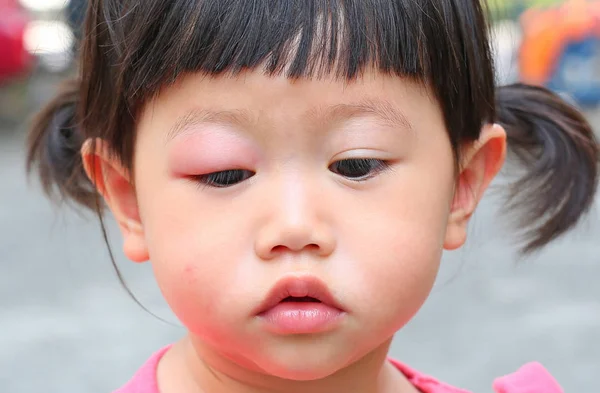 Asiatique bébé fille oeil houle, Allergie après les moustiques mordant à l'oeil petite fille — Photo