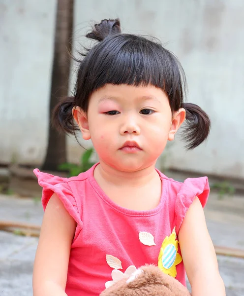 Asiatiska baby flicka öga svälla, allergi efter myggor biter på ögat liten flicka — Stockfoto