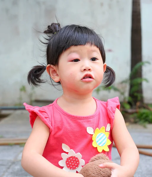 Asiático bebé niña ojo hinchazón, alergia después de mosquitos picadura en ojo chica pequeña —  Fotos de Stock
