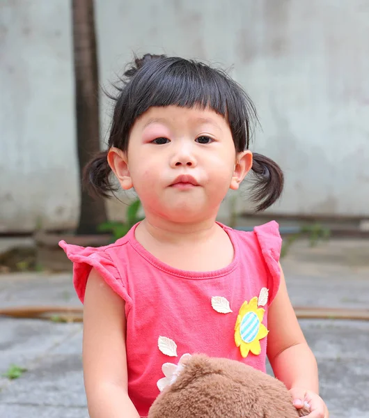 Asiatiska baby flicka öga svälla, allergi efter myggor biter på ögat liten flicka — Stockfoto