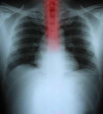 Xray of a human thorax with esophagus highlighted in red clipart
